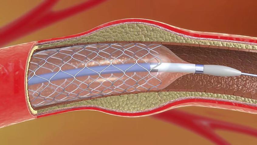 心梗吃什么药速效救心丸,心梗可用丹参和什么药配伍