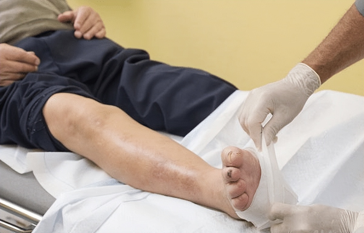 所有的灰指甲,灰指甲的危害到底有多大