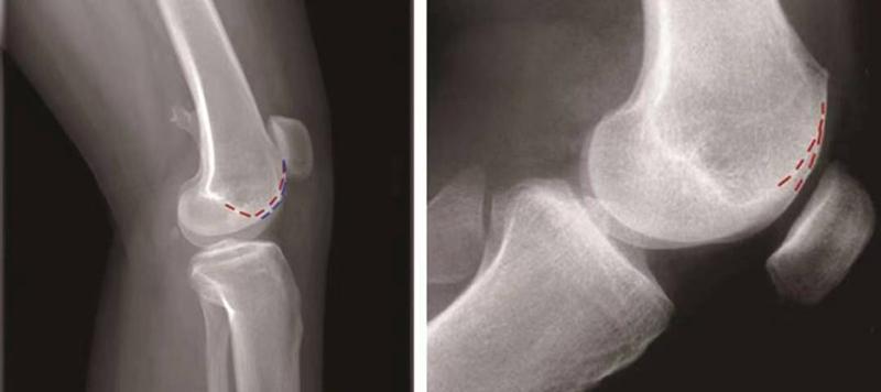 髌骨骨折评估,髌骨上下滑动评估什么内容