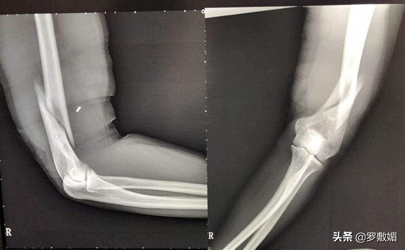 高中生掰手腕骨折谁负责,高中生掰手腕一方骨折谁承担责任