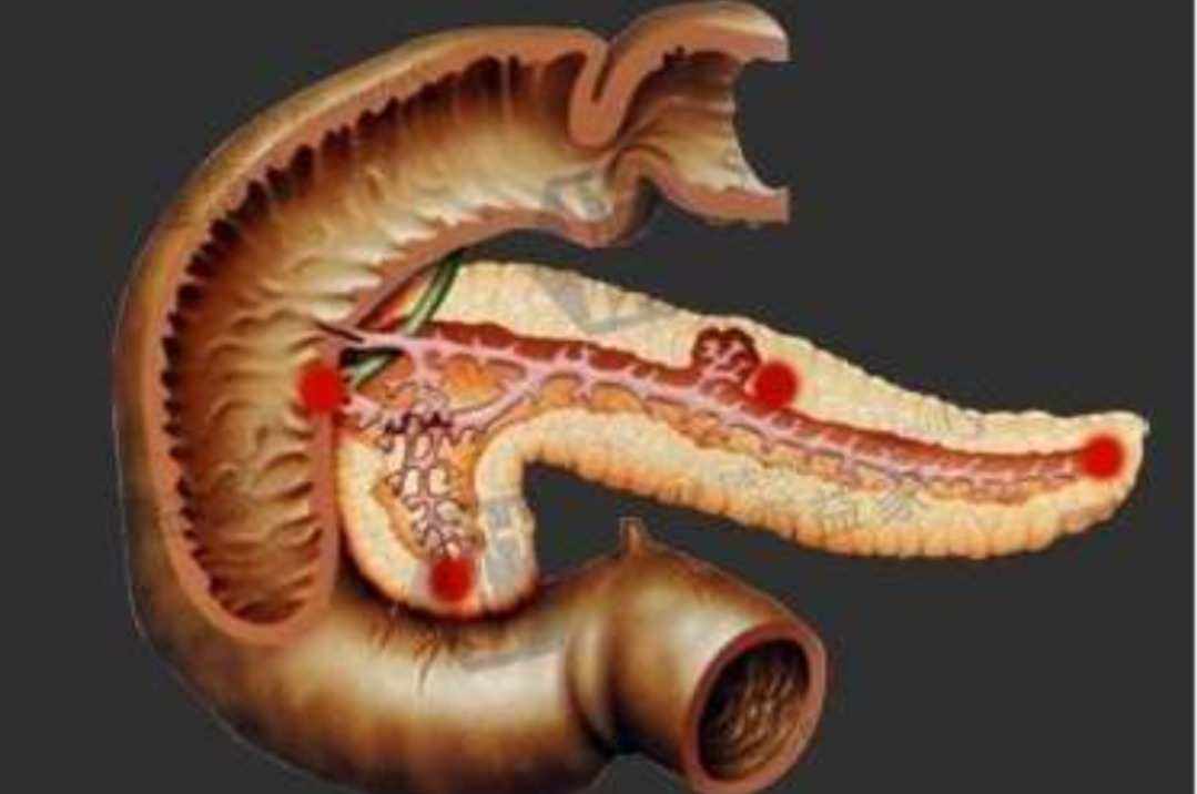 腹腔镜下胆总管切开取石治疗,充填型胆囊结石用腹腔镜怎样切除