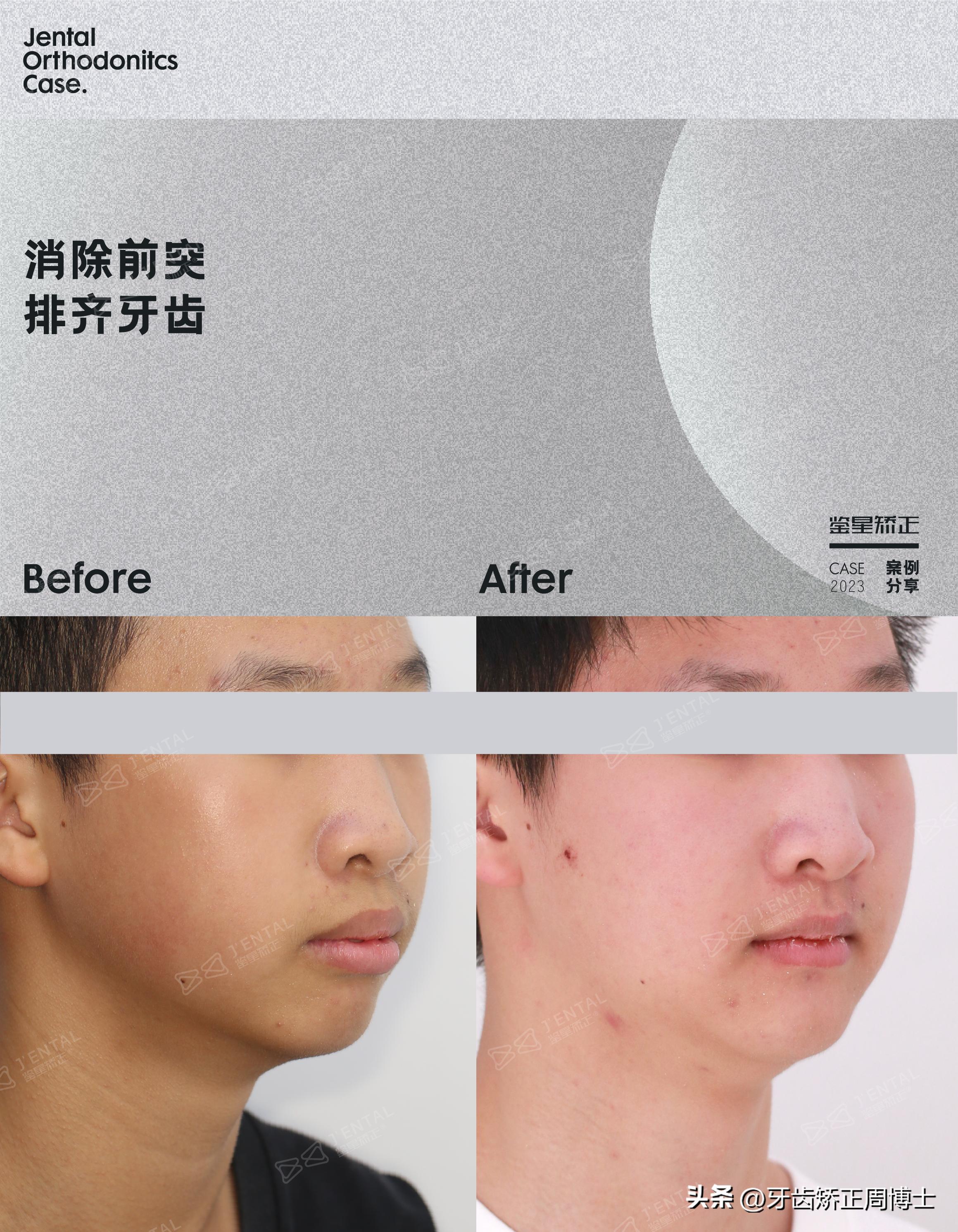 拔掉大牙做矫正好还是植牙好,拔掉4颗牙齿正畸收缝有几种方法