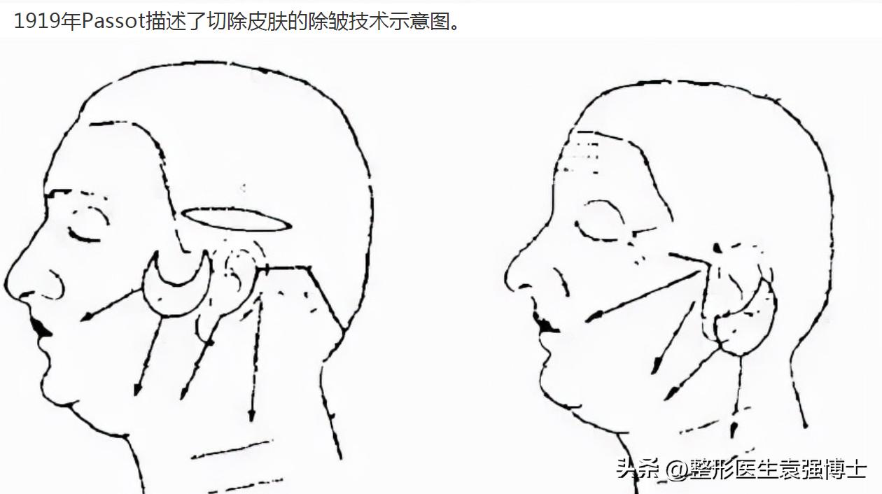 拉皮不剥离会留疤明显吗,拉皮手术如何防止留疤