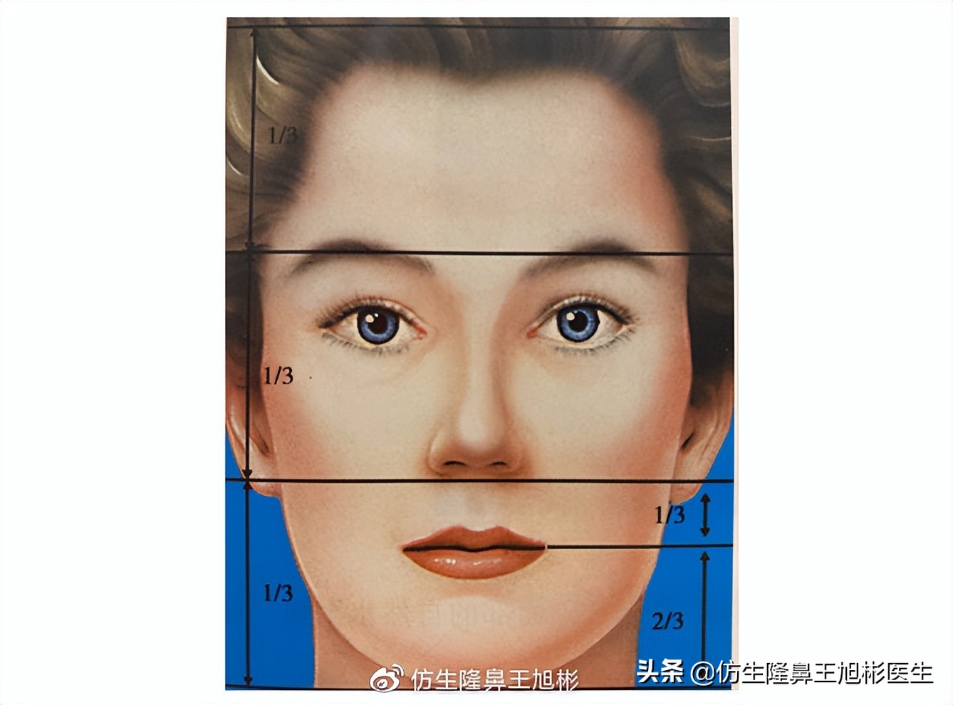 短鼻蒜头鼻整形,短鼻延长术切口