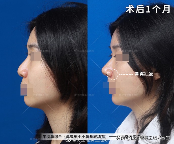 常见鼻部整形美容项目,整形鼻和自然鼻