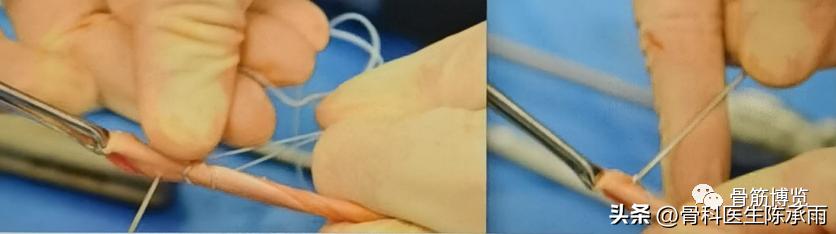 肱二头肌长头肌腱断裂超声报告,上臂肱二头肌