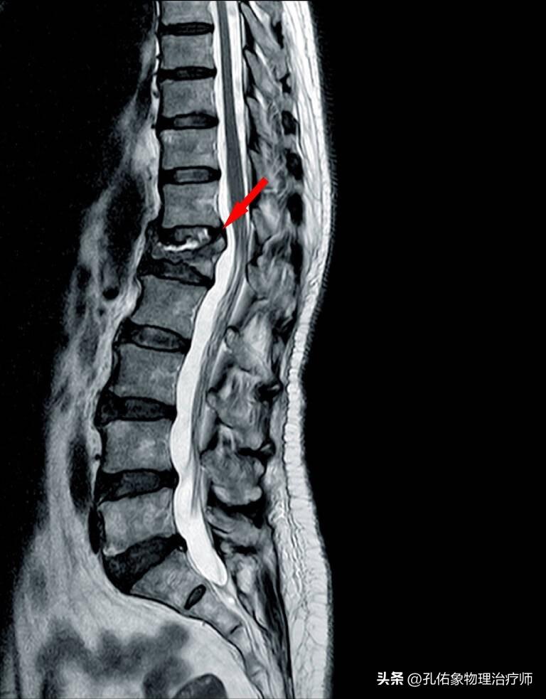 老年人腰部压缩性骨折怎么治疗,腰部压缩骨折多久才能恢复