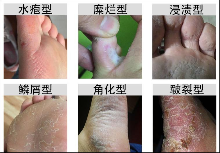 治脚气小生意,脚气加盟店