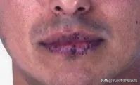 口唇黑斑是息肉还是肿瘤,嘴唇黑斑查出肠癌