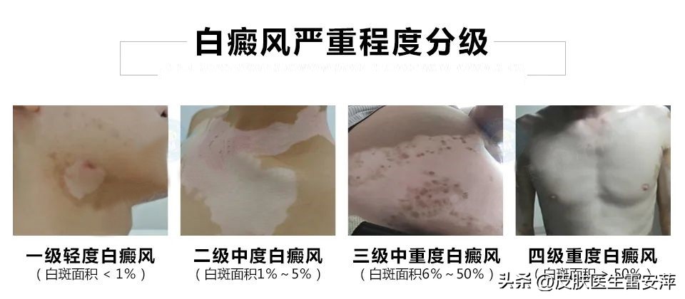 皮肤上突然黄了一块,突然有块地方变白是白癜风吗