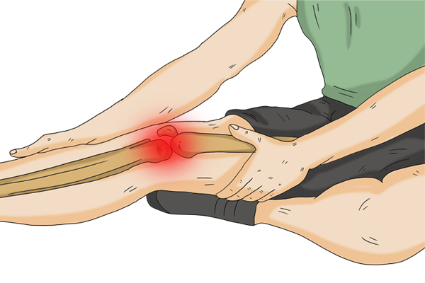 半月板前角损伤自测方法,半月板损伤膝盖疼教你一个动作