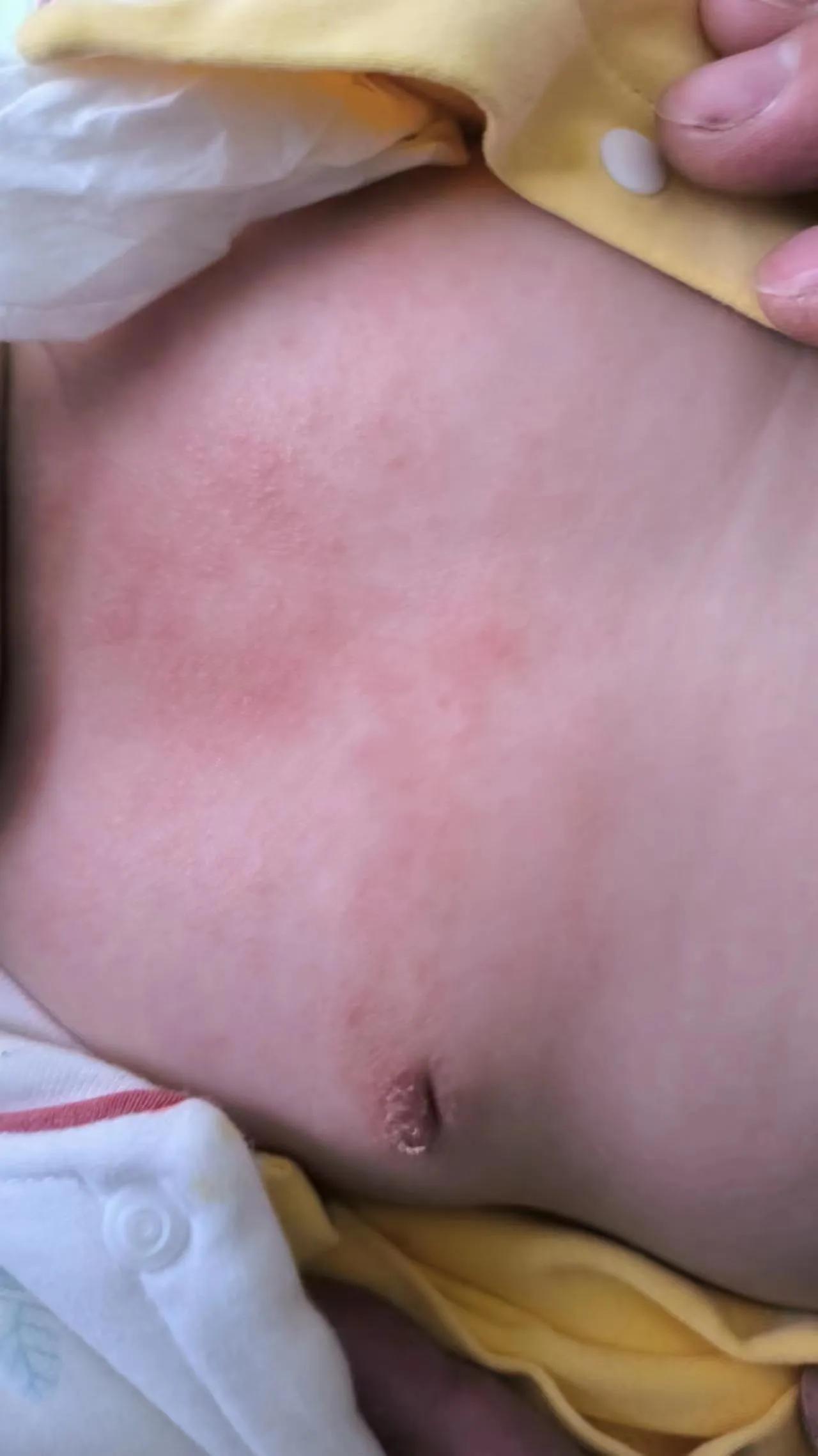 多年的湿疹自愈了,治好湿疹的经历