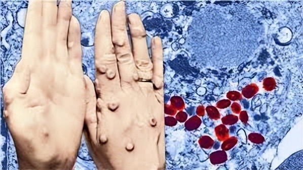 十大毁灭人类的病毒,地球上最强的5种病毒