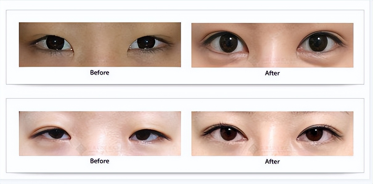 5d双眼皮手术疼不疼,双眼皮手术第六天感觉有点疼