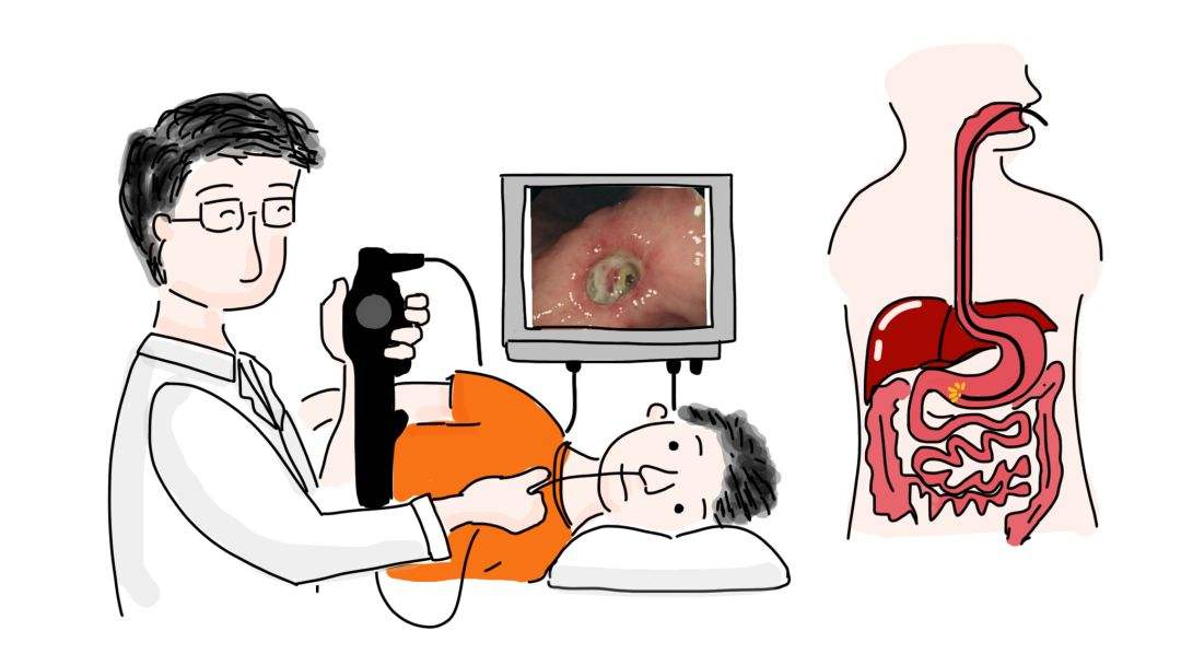 无痛肠胃胃镜检查全过程,胃有问题的胃镜检查全过程