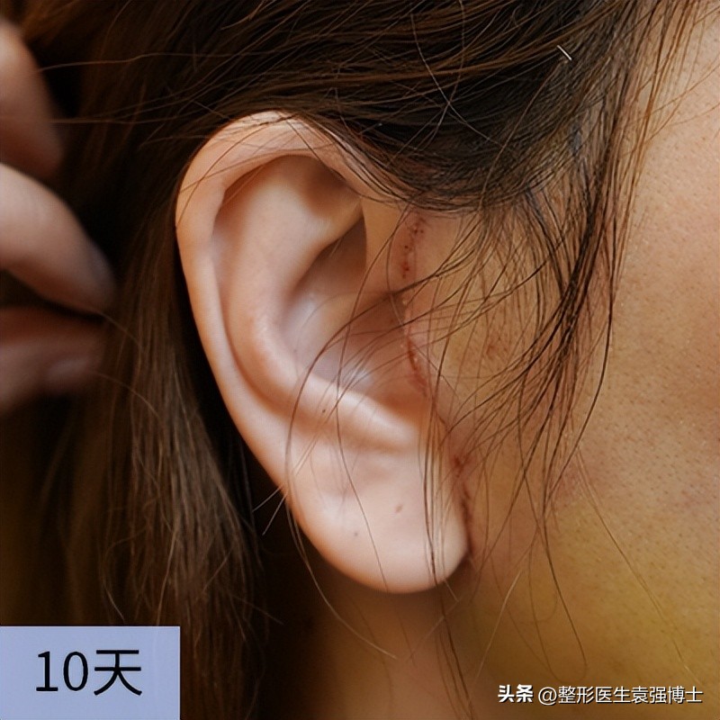 拉皮术后1-7天照片,科普一波大拉皮手术恢复期多少天