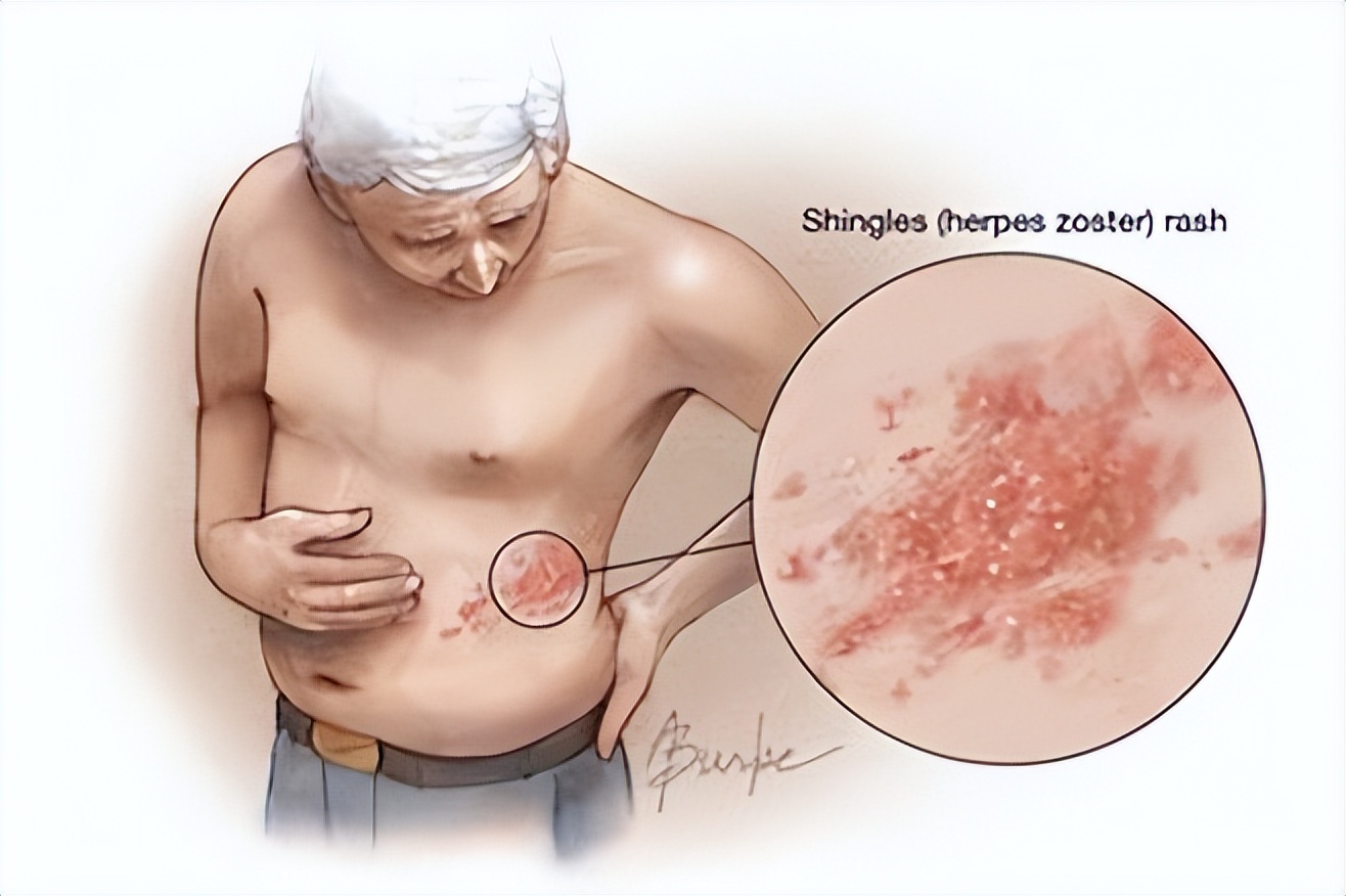 带状疱疹疫苗1401多少钱一支,带状疱疹疫苗有必要打几针