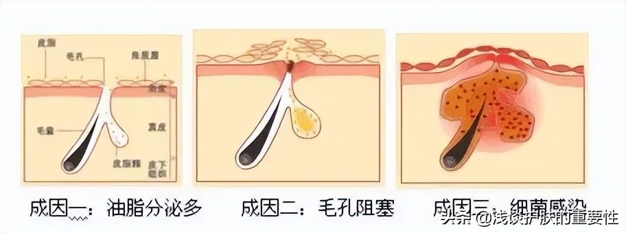 90%的女生皮肤爱出油都是因为这个，教你2招护肤变清爽