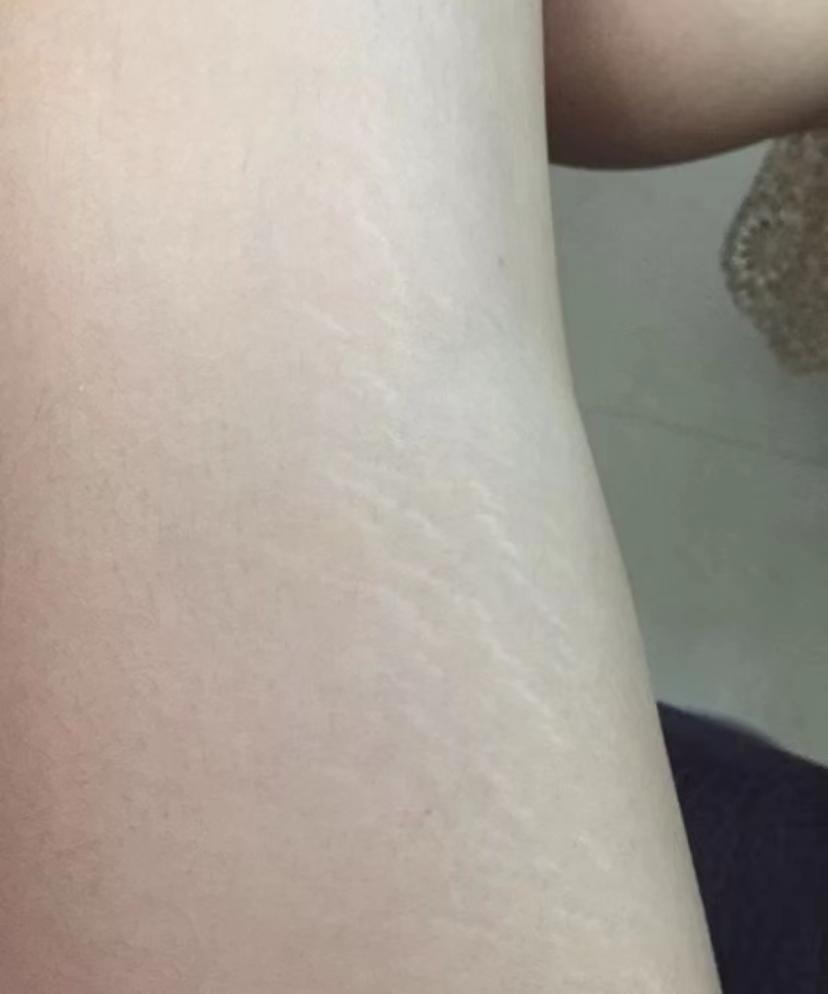 妊娠油有什么坏处,妊娠油有必要用嘛