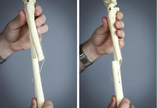 第一掌骨基底部骨折手法复位,骨折手法复位原理