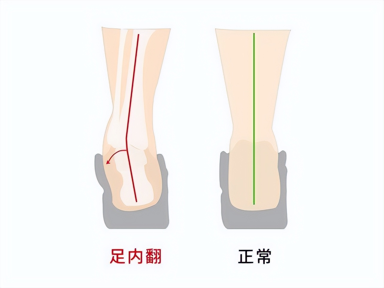 个人怎么判断跟骨内翻,如何诊断前足内翻