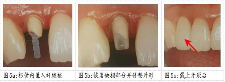 口腔纤维桩优点与缺点,口腔打纤维桩的条件