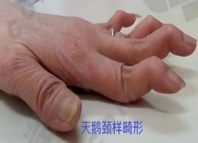 风湿免疫类疾病最怕什么,风湿免疫疾病如何预防