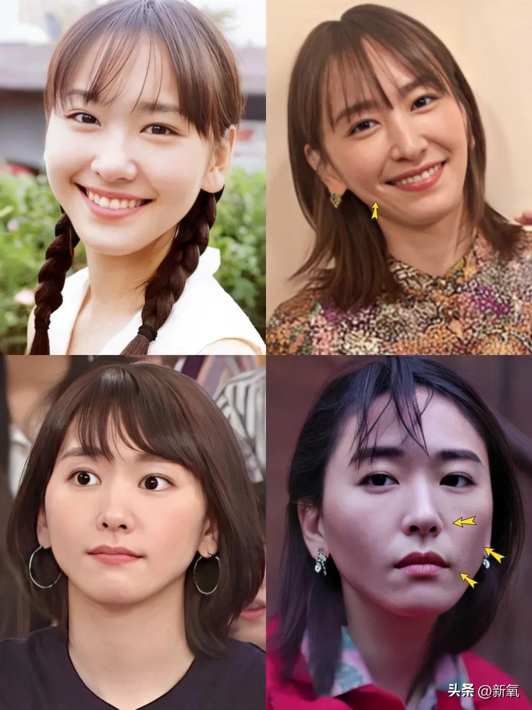 牙齿正畸和骨骼正畸的区别,牙齿正畸和眼轴增长有关系吗