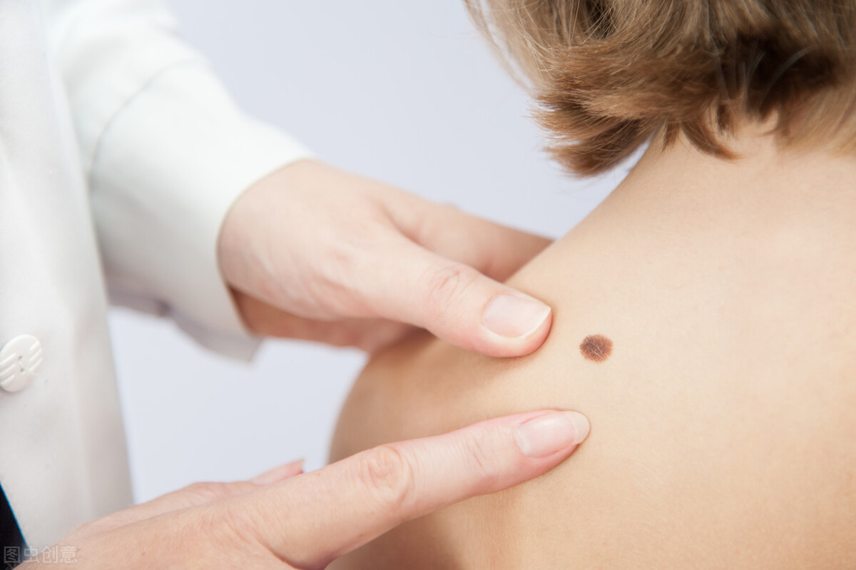 痣变大会是癌变吗,痣变大就是癌变了吗