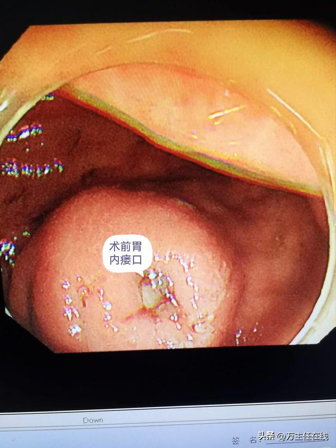 腹腔粘液癌治疗有妙招——万荣教授以内镜Notes技术成功胃减压