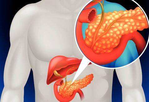 胰腺癌前兆是慢性胰腺炎吗,胰腺炎有哪些自我救治措施