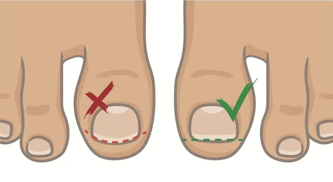 脚趾甲老往肉里钻，一碰还疼？教你小妙招，预防甲沟炎告别疼痛