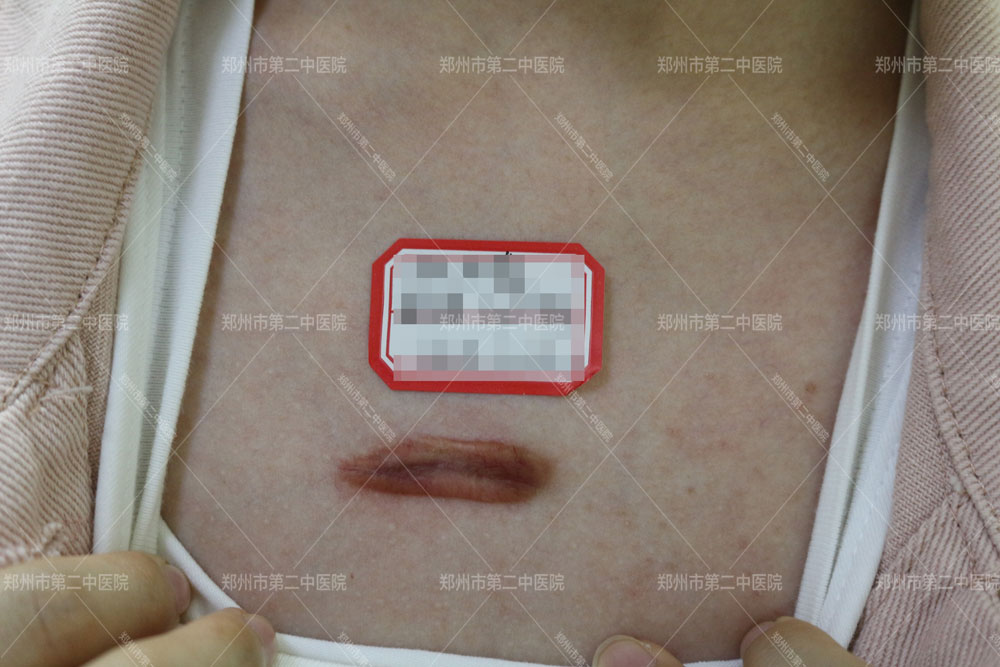 胸前疤痕疙瘩最新治疗知名专家,胸前疤痕疙瘩郑州哪家医院好