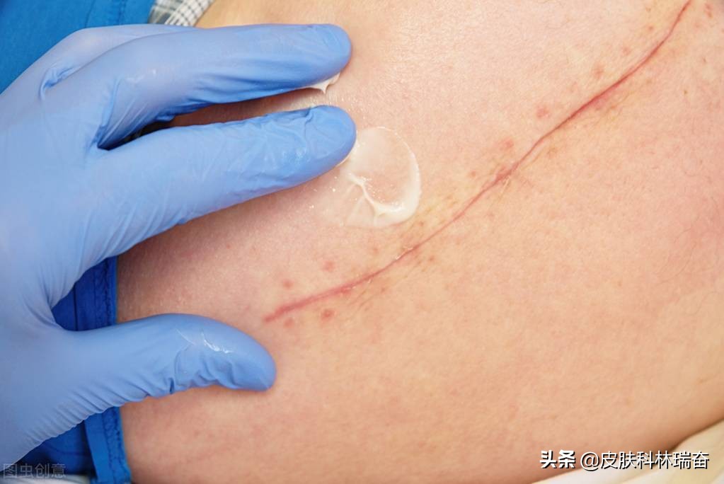 目前治疗疤痕最省钱的三种方法,疤痕消除手术有几种