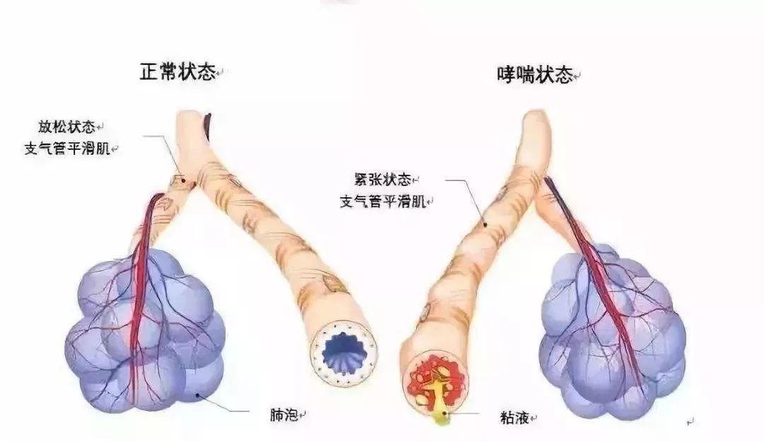 哮喘感觉呼吸很累,哮喘患者呼吸锻炼