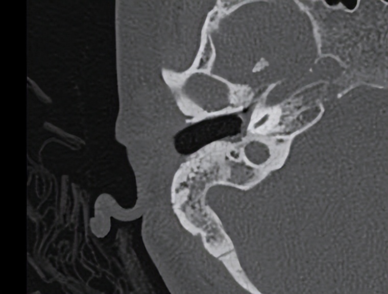 中耳炎耳内镜微创手术,慢性中耳炎流脓能做微创吗