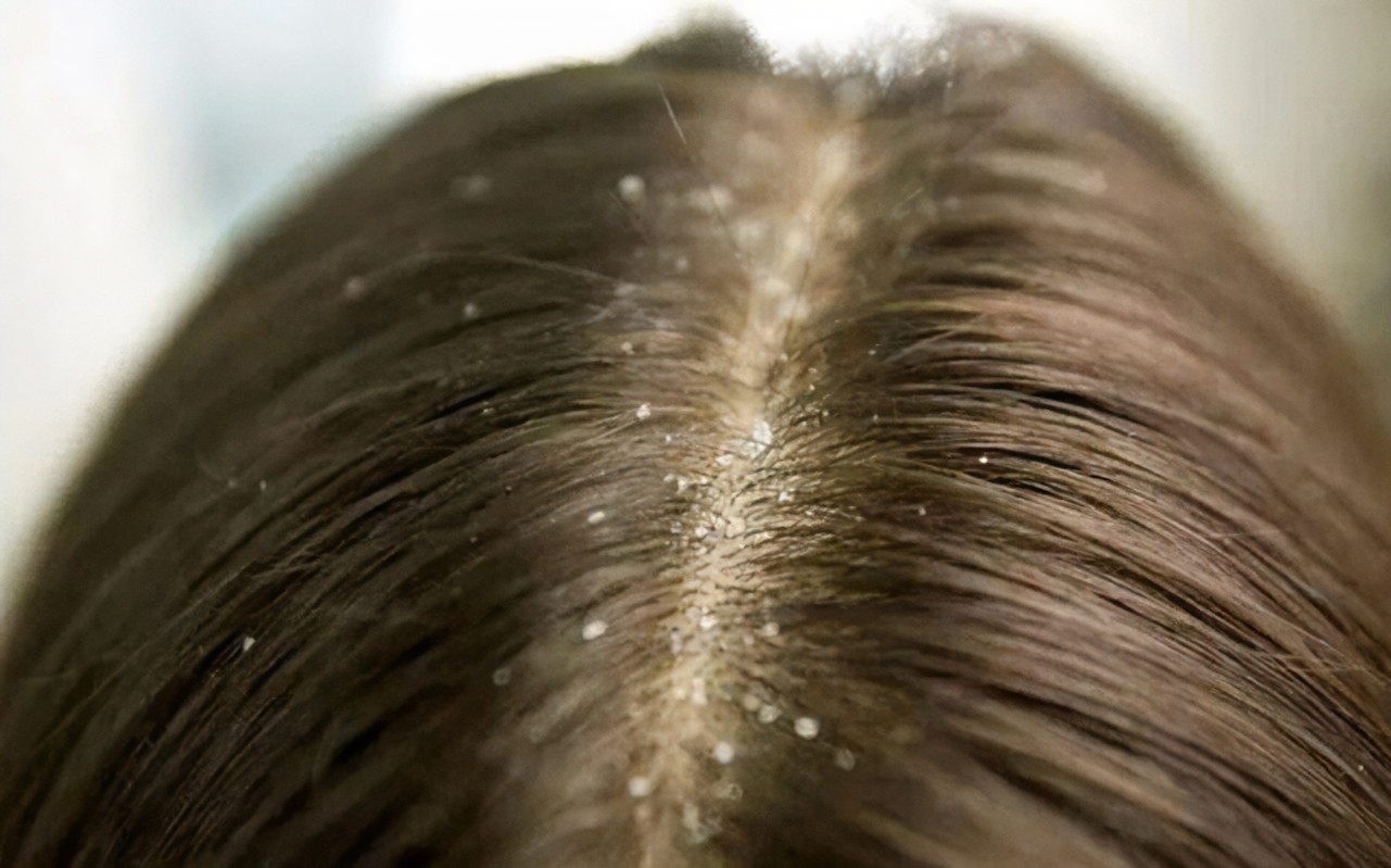 有头皮屑头皮痒以前没有头皮屑,头皮屑多头皮痒怎么治疗