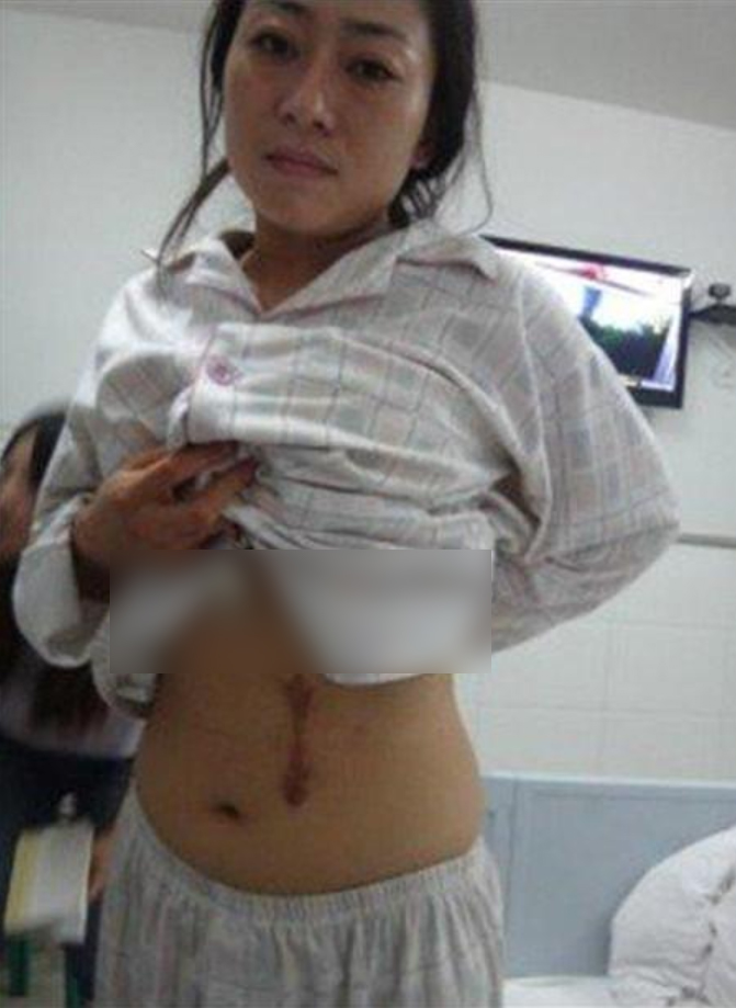 女子体检意外发现左肾不见了,偷切除左肾事件