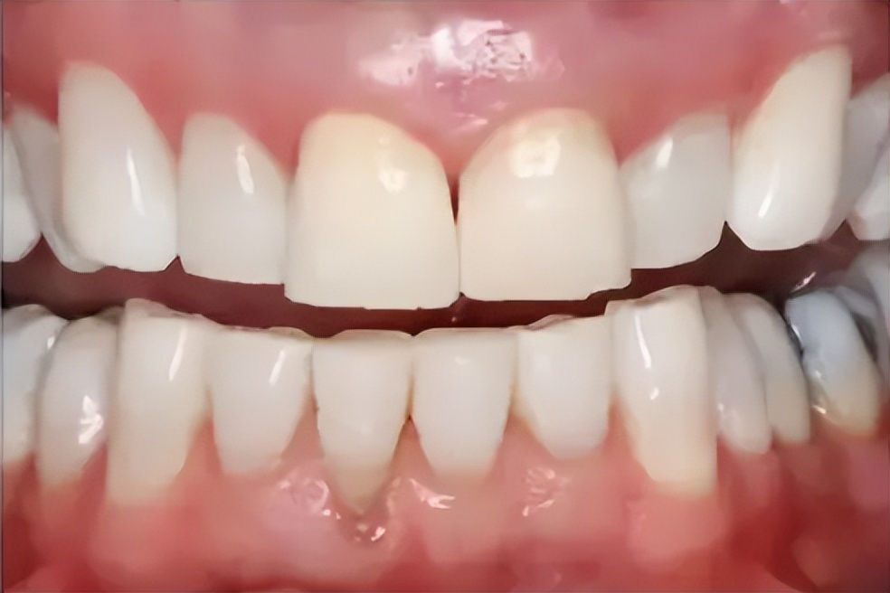 牙齿变黄口臭三分钟搞定,如何能快速解决牙齿口臭口黄