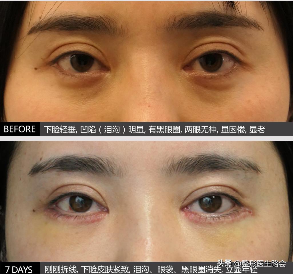 40岁泪沟用什么填充最好,40岁眼袋泪沟最好的解决方法