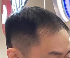 花费四万元植发一年后效果仍不明,男生大面积植发八个月真实效果