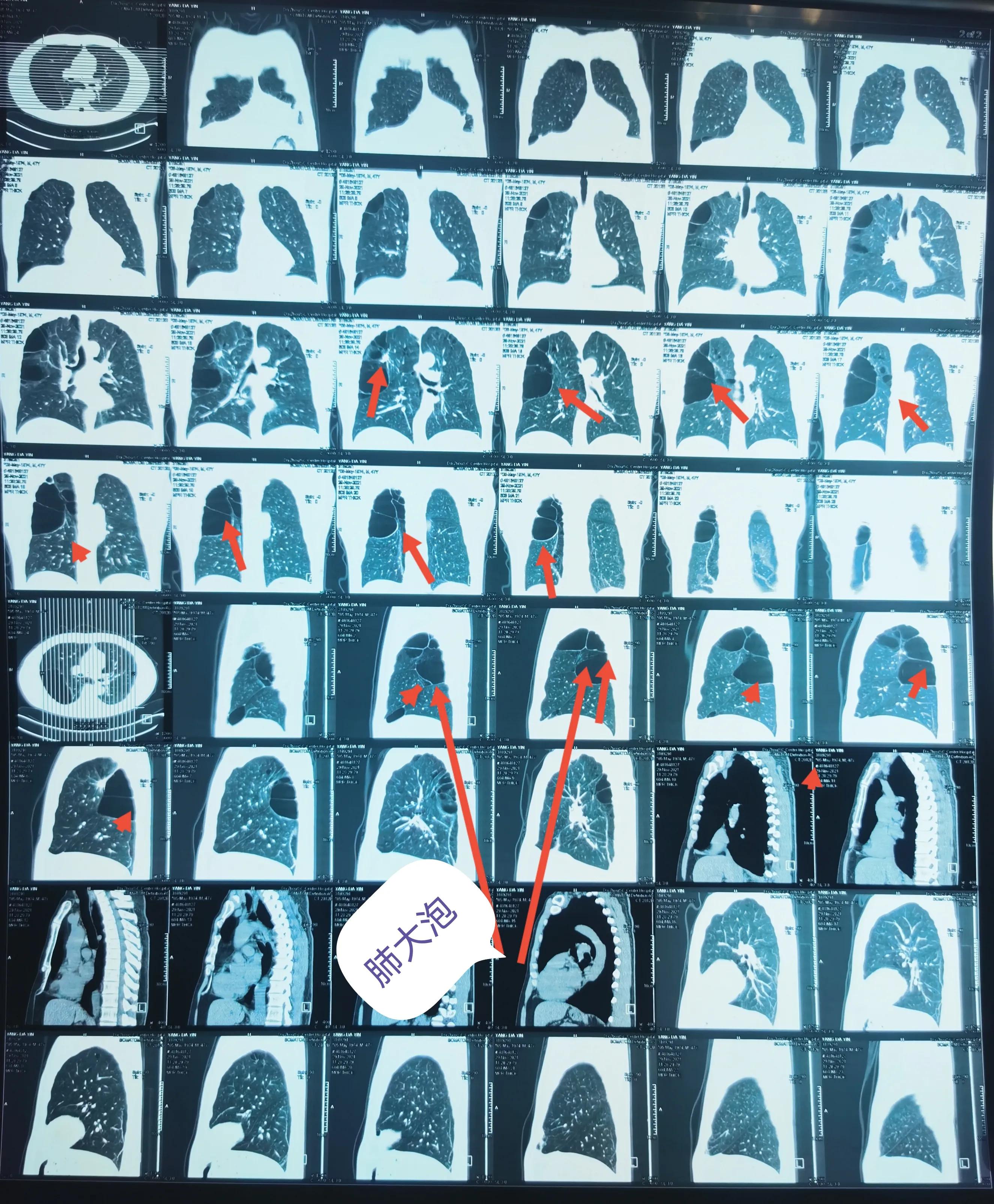 肺大泡产生的原因及治疗方案,肺大泡怎么治疗断根