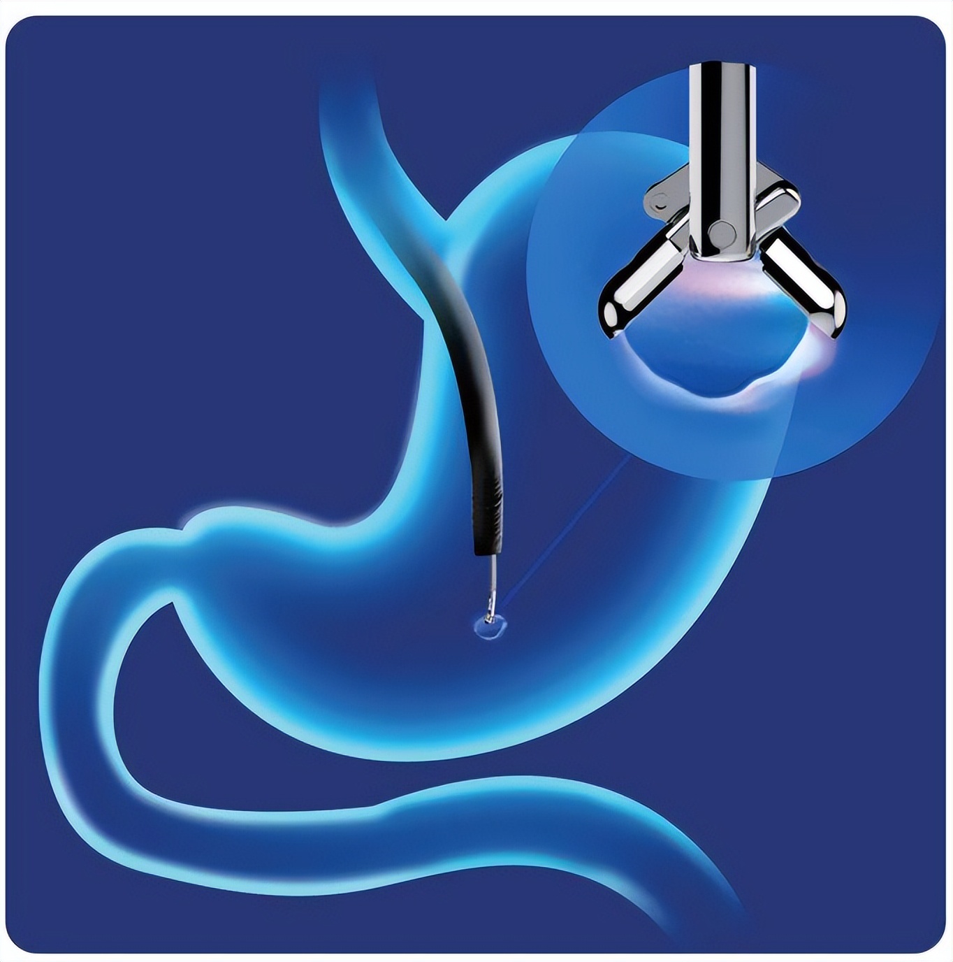 胃肠镜活检ps啥意思,胃肠镜活检主要是干什么的