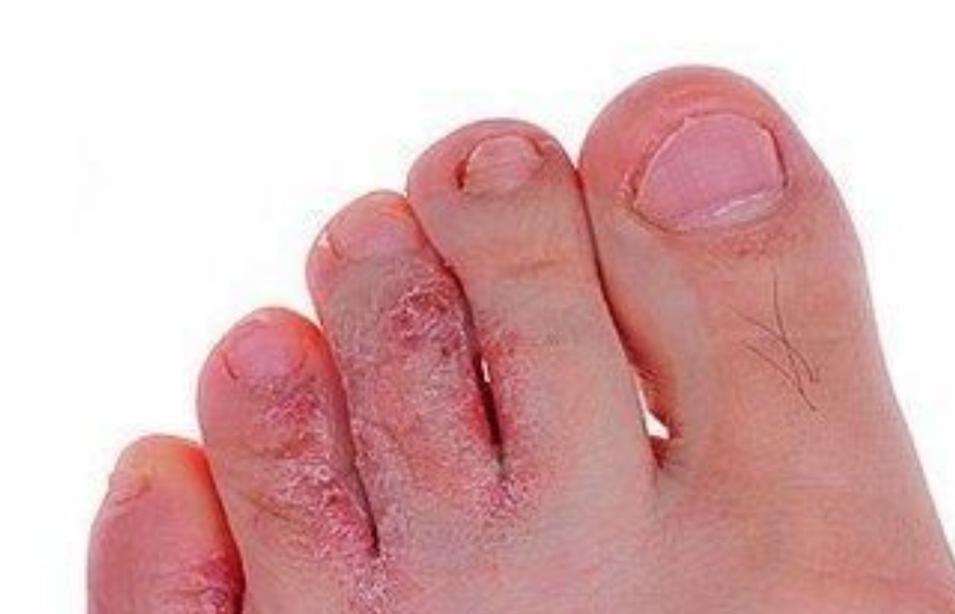 手足癣反复怎么办,患了手足癣该怎么治最好