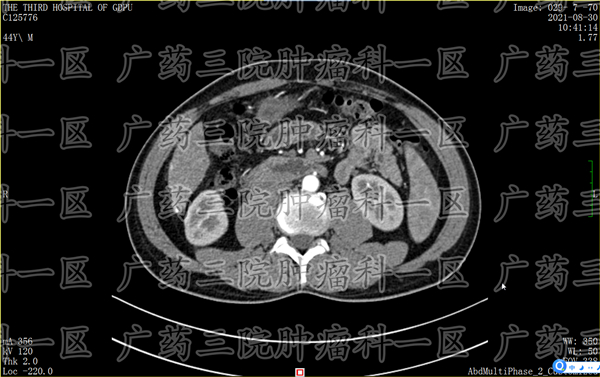 肝内胆管癌的中晚期术后治疗,肝内胆管癌吃什么中成药