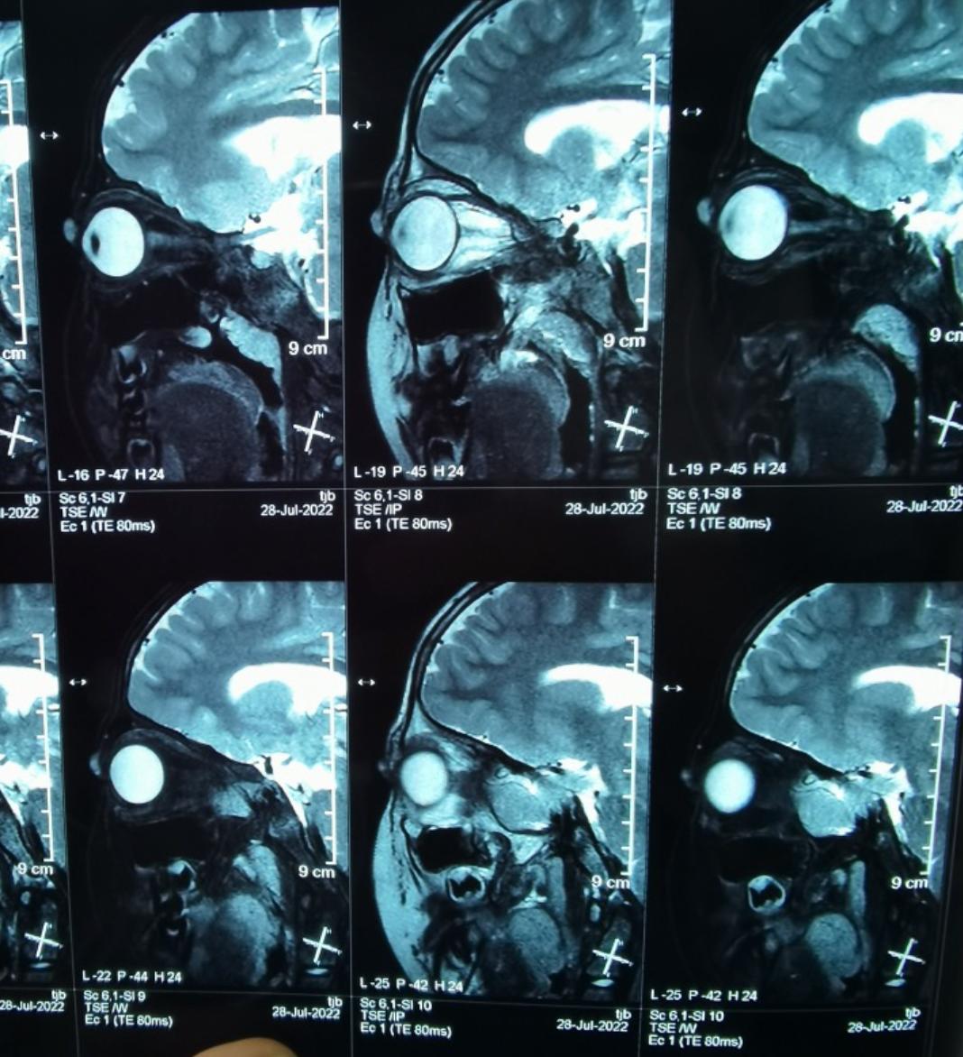 成人先天性眼睛长了血管瘤怎么办,新生儿血管瘤和先天性血管瘤