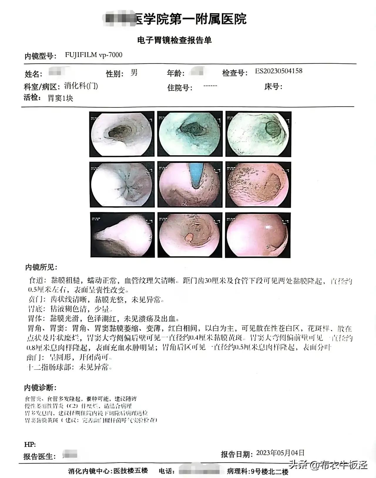肠胃镜查到有小息肉需要切除吗,做胃肠镜发现有息肉是否直接取出