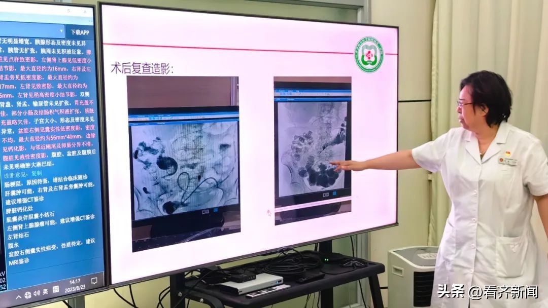 齐医附属三院MDT：打破学科壁垒！患者不动医生动