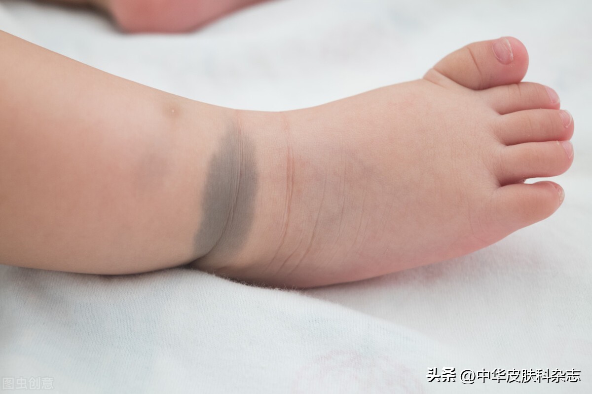 身上长咖啡色斑图片,孩子身上有咖啡色的斑是什么原因