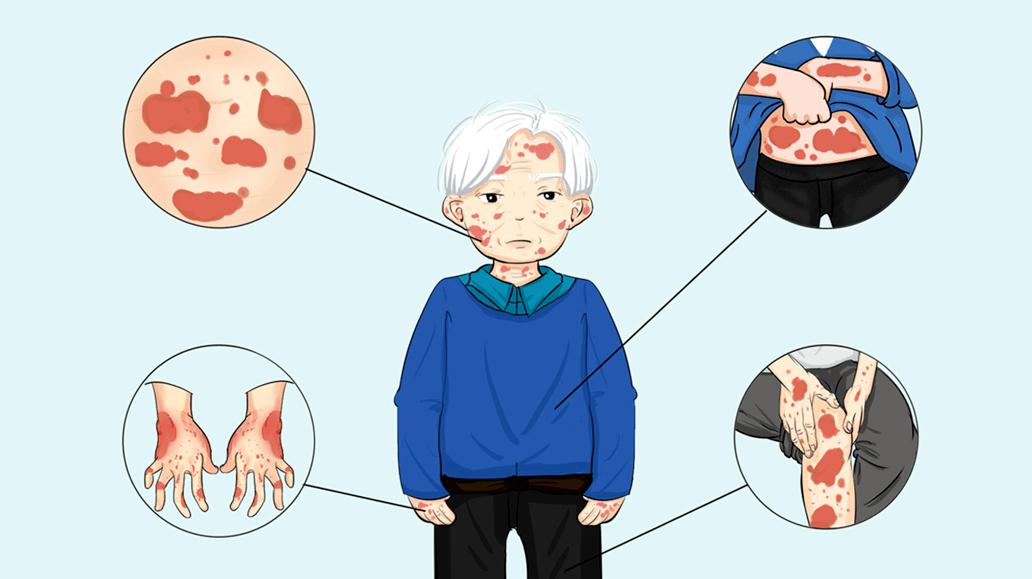 银屑病易与哪些皮肤病混淆,银屑病在人群中的比例